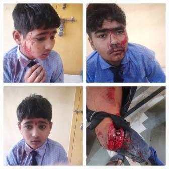 हाथरस में बड़ा हादसा : स्कूल जाते समय ऑटो-बस में टक्कर, तीन सगे भाई घायल, एक की हालत गंभीर