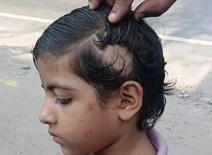 LKG छात्रा से मारपीट और बाल उखाड़ने का आरोप, शिक्षिका निलंबित